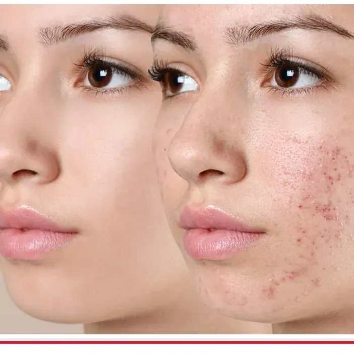 Acne Treatment