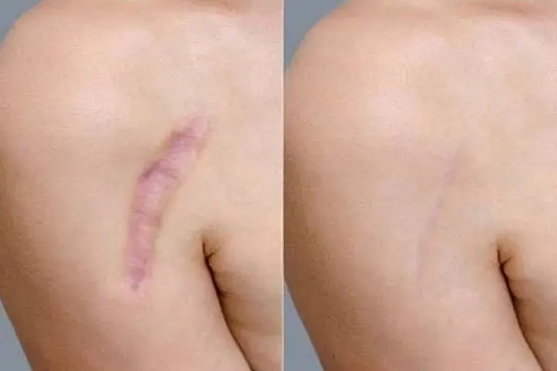 Body Scar Revision