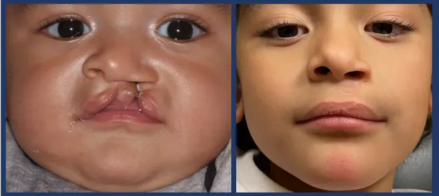 Cleft Lip Surgery