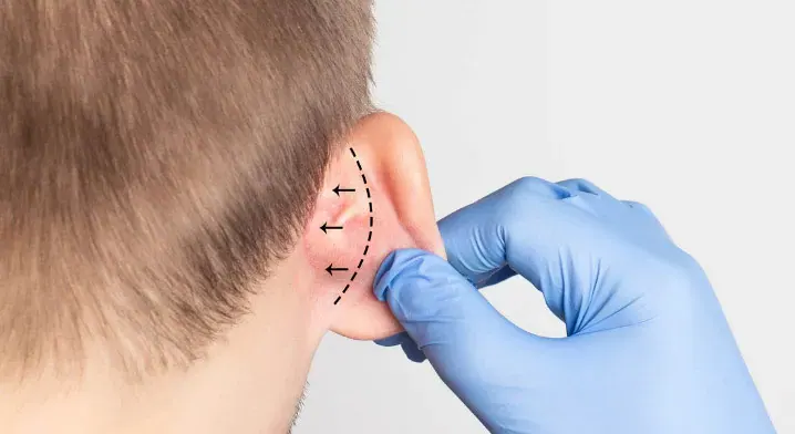 Ear Surgery (Otoplasty)