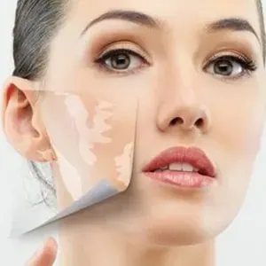 Face Scar Surgery (Scar Revision)