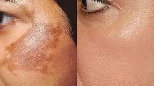 Pigmentation in Aligarh — Dr. Amit Agrawal